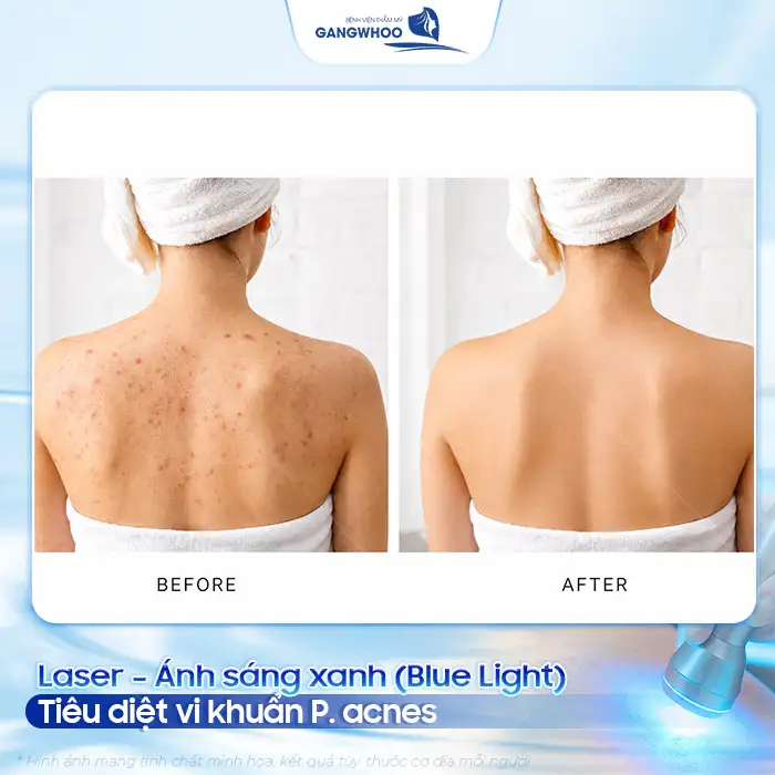Phác đồ điều trị mụn lưng và viêm nang lông hiệu quả, an toàn