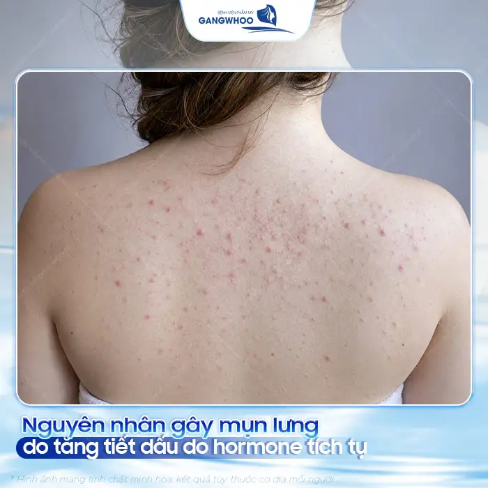 Phác đồ điều trị mụn lưng và viêm nang lông hiệu quả, an toàn