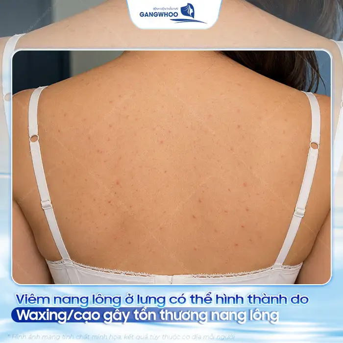 Phác đồ điều trị mụn lưng và viêm nang lông hiệu quả, an toàn