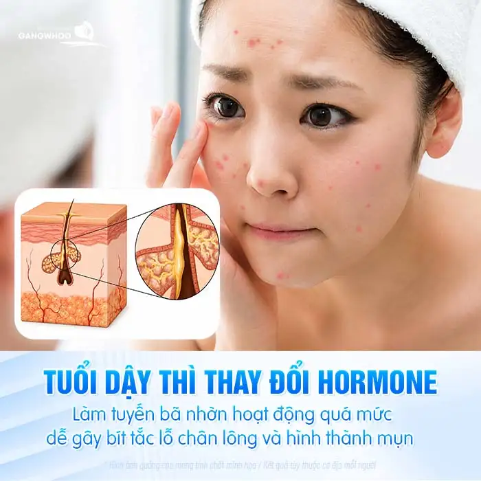 Hướng dẫn điều trị mụn tuổi dậy thì hiệu quả, an toàn cho làn da