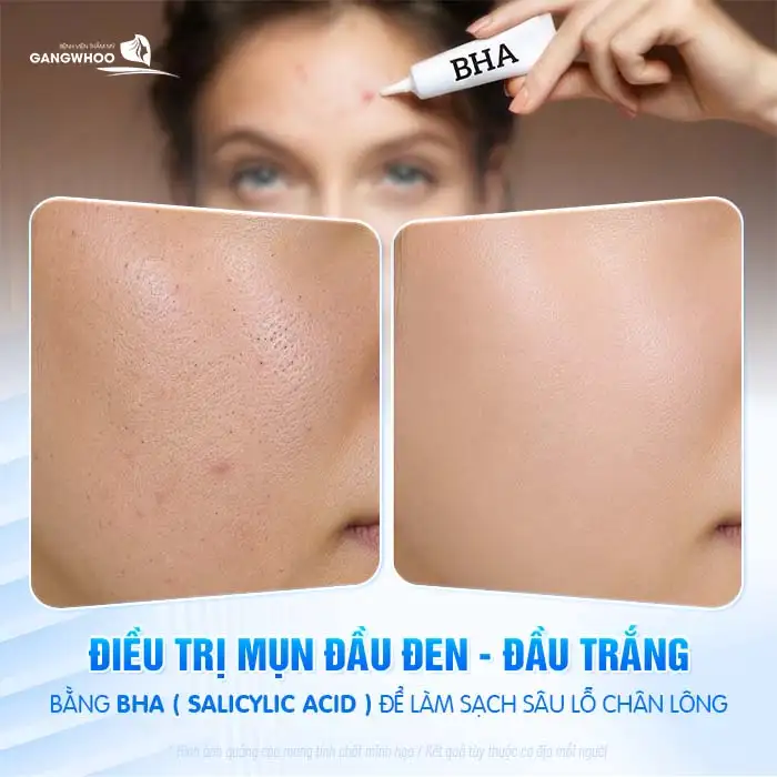 Hướng dẫn điều trị mụn tuổi dậy thì hiệu quả, an toàn cho làn da