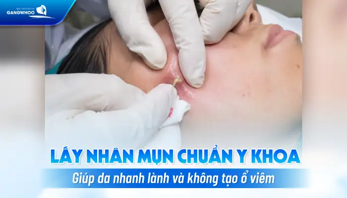 Cách điều trị mụn u nang an toàn, hiệu quả tránh gây sẹo xấu