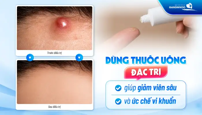 Cách điều trị mụn u nang an toàn, hiệu quả tránh gây sẹo xấu