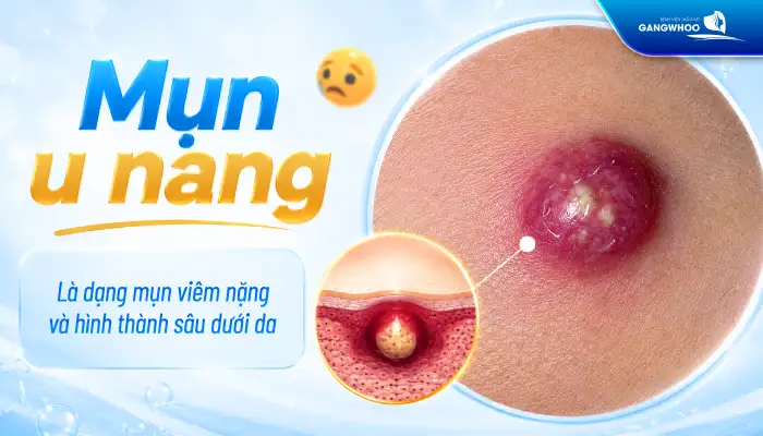 Cách điều trị mụn u nang an toàn, hiệu quả tránh gây sẹo xấu