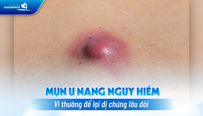 Cách điều trị mụn u nang an toàn, hiệu quả tránh gây sẹo xấu