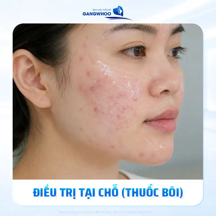 Cách điều trị mụn viêm đỏ nhanh và an toàn chuẩn y khoa