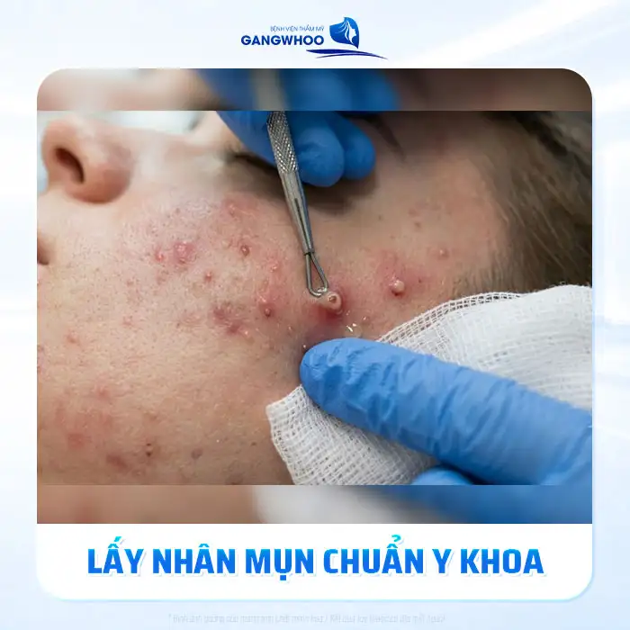 Cách điều trị mụn viêm đỏ nhanh và an toàn chuẩn y khoa