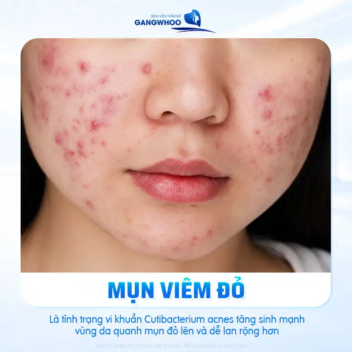 Cách điều trị mụn viêm đỏ nhanh và an toàn chuẩn y khoa