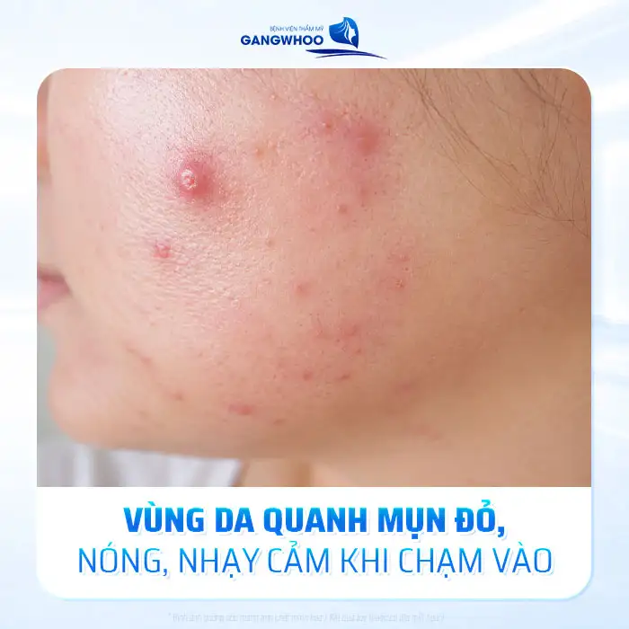Cách điều trị mụn viêm đỏ nhanh và an toàn chuẩn y khoa