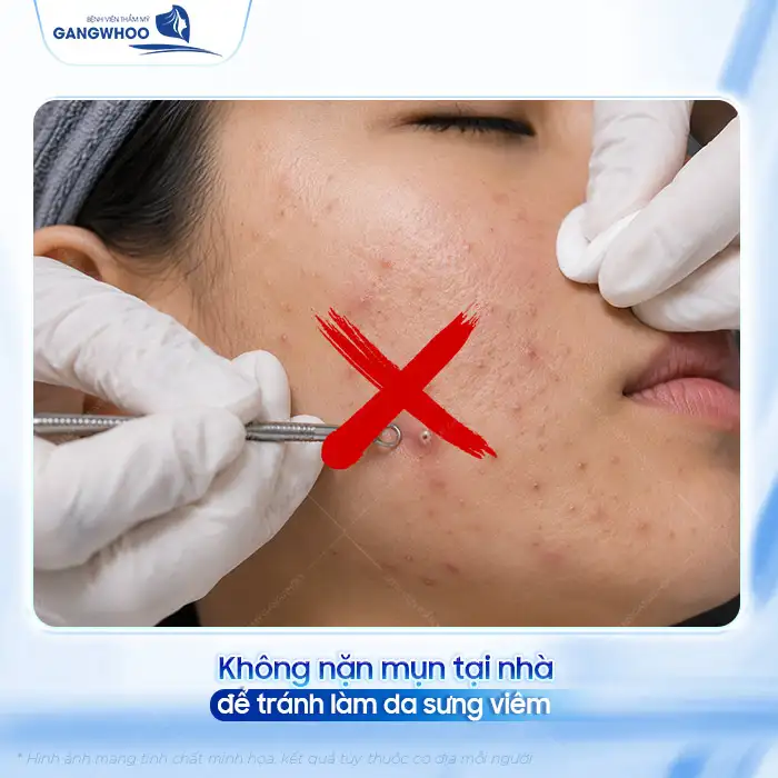 Điều trị thâm mụn bằng laser có hiệu quả không? Quy trình ra sao?