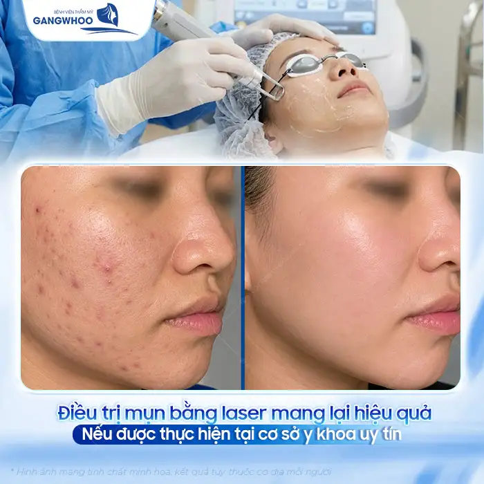 Điều trị thâm mụn bằng laser có hiệu quả không? Quy trình ra sao?
