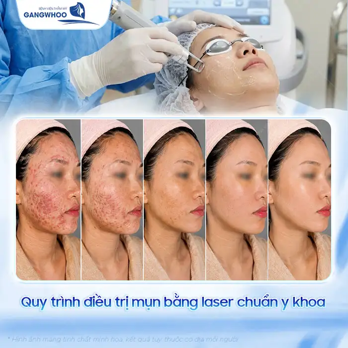Điều trị thâm mụn bằng laser có hiệu quả không? Quy trình ra sao?