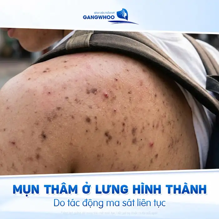 Điều trị vết thâm mụn ở lưng nhanh, an toàn và hiệu quả