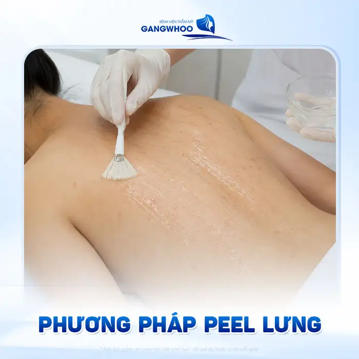 Điều trị vết thâm mụn ở lưng nhanh, an toàn và hiệu quả