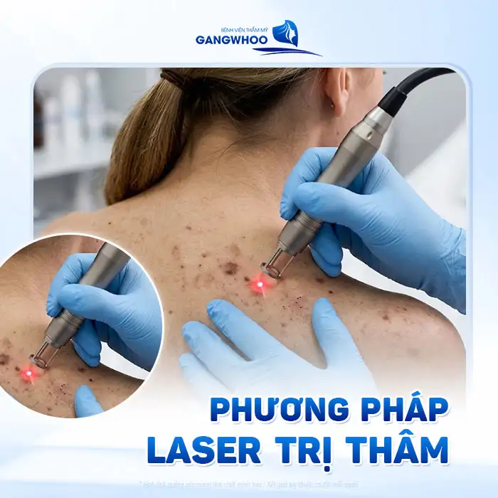 Điều trị vết thâm mụn ở lưng nhanh, an toàn và hiệu quả