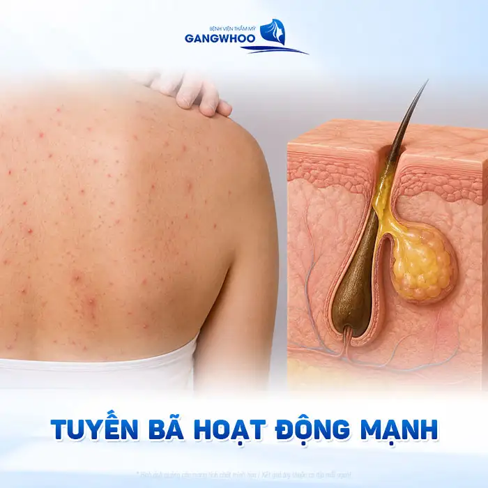 Điều trị vết thâm mụn ở lưng nhanh, an toàn và hiệu quả