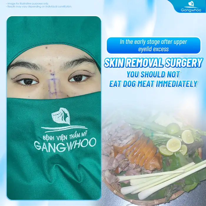 Cắt mí có được uống trà sữa không? Bao lâu thì được uống trà sữa