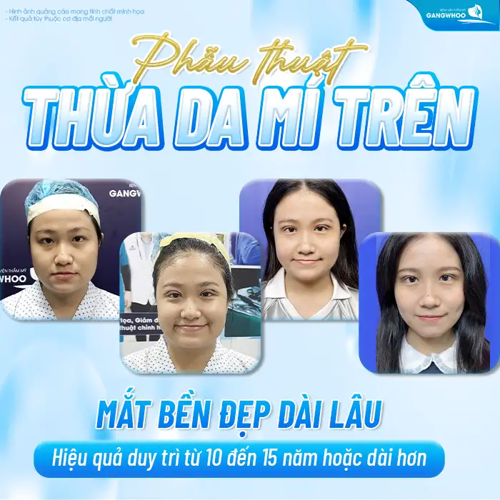 Cắt mí mini deep giữ được bao lâu? Có giữ được vĩnh viễn không?