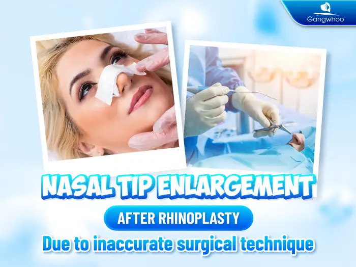 When Does a Bulky Nasal Tip After Rhinoplasty Return to Normal?