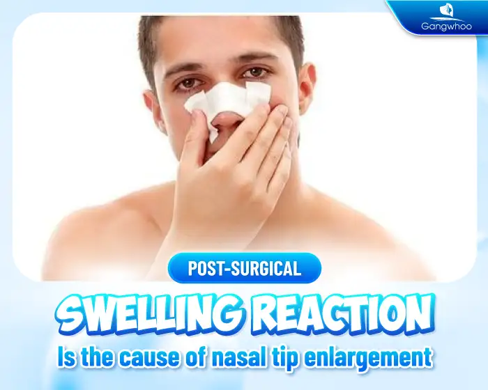 When Does a Bulky Nasal Tip After Rhinoplasty Return to Normal?
