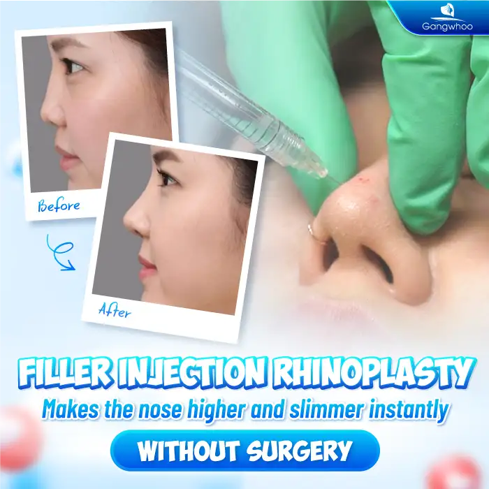 Should You Get Dermal Fillers or Rhinoplasty? What Are the Pros and Cons of Each Method?