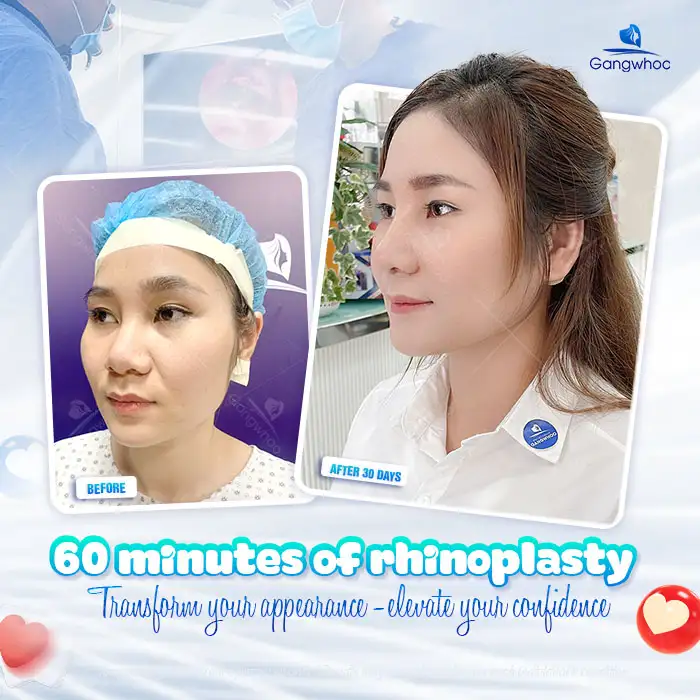 Should You Get Dermal Fillers or Rhinoplasty? What Are the Pros and Cons of Each Method?