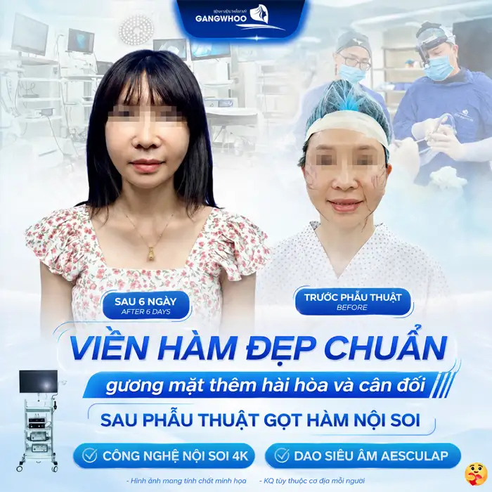Gọt hàm bao lâu thì hết sưng? Cách chăm sóc giúp giảm sưng hiệu quả