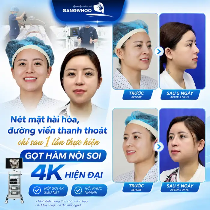Gọt hàm bao lâu thì hết sưng? Cách chăm sóc giúp giảm sưng hiệu quả