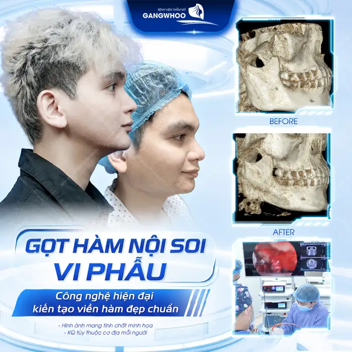 Gọt hàm bao lâu thì hết sưng? Cách chăm sóc giúp giảm sưng hiệu quả