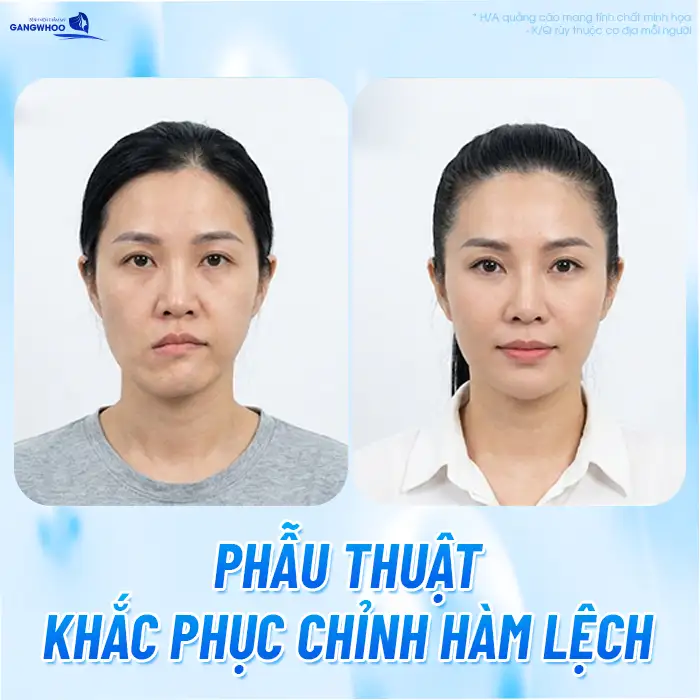 Gọt hàm bị lệch nguyên nhân do đâu? Cách khắc phục tình trạng ra sao?