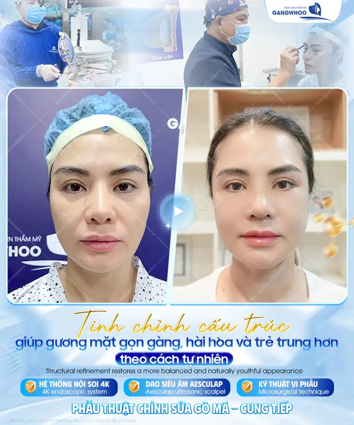 Gọt hàm hạ gò má giá bao nhiêu? Chi phí gọt hàm mới nhất 2026