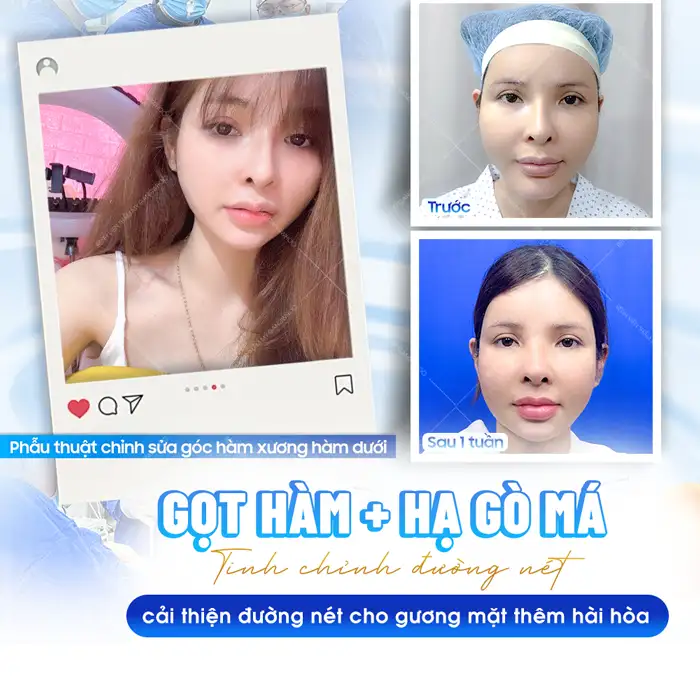 Gọt hàm hạ gò má giá bao nhiêu? Chi phí gọt hàm mới nhất 2026