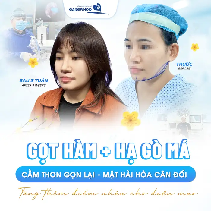 Gọt hàm hạ gò má giá bao nhiêu? Chi phí gọt hàm mới nhất 2026