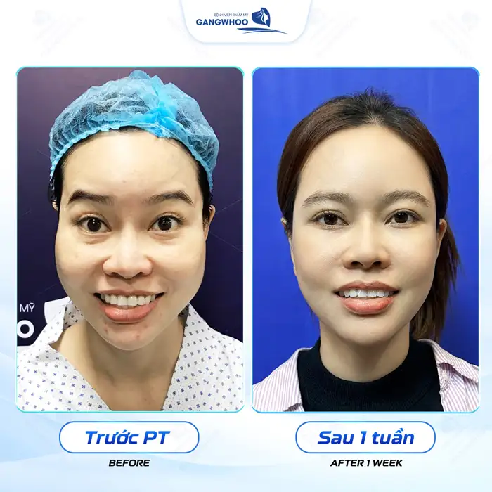 Gọt hàm hạ gò má giá bao nhiêu? Chi phí gọt hàm mới nhất 2026