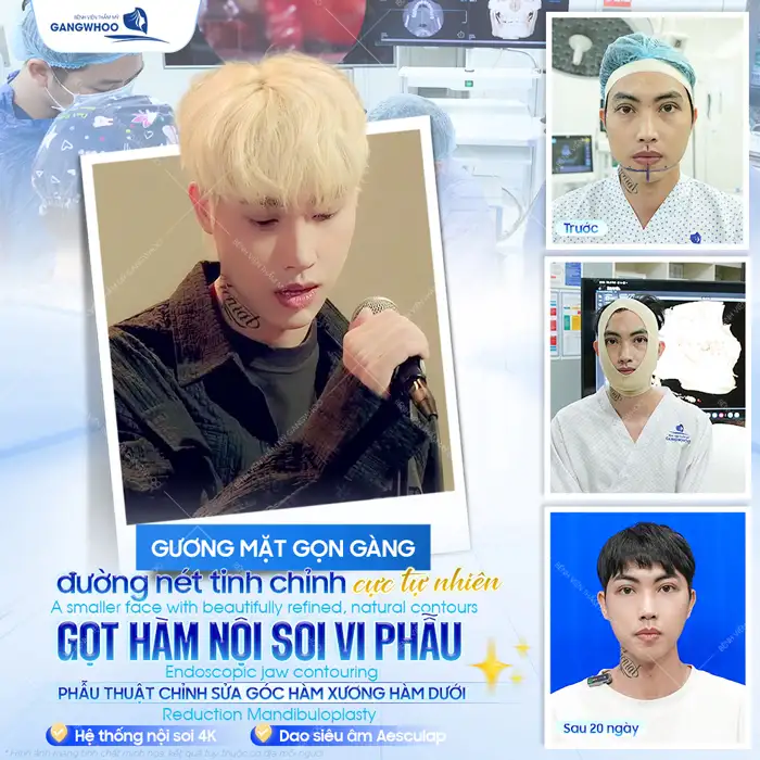 Gọt hàm hô giá bao nhiêu? Cập nhật bảng giá gọt hàm mới nhất 2026