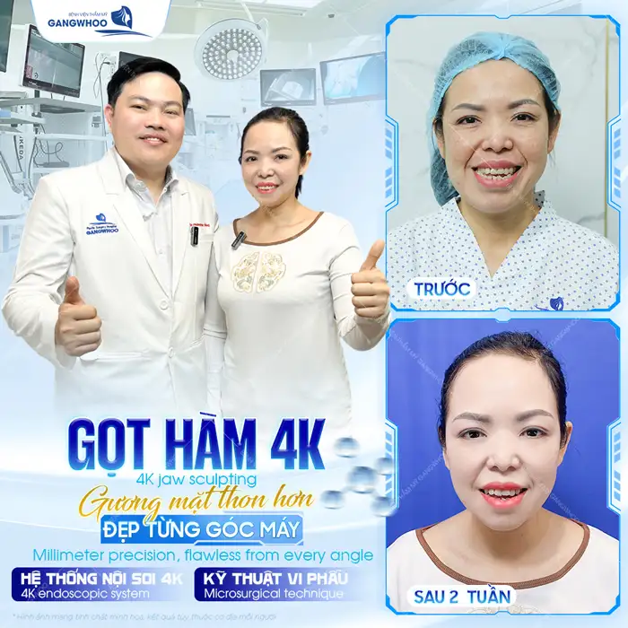 Gọt hàm hô giá bao nhiêu? Cập nhật bảng giá gọt hàm mới nhất 2026