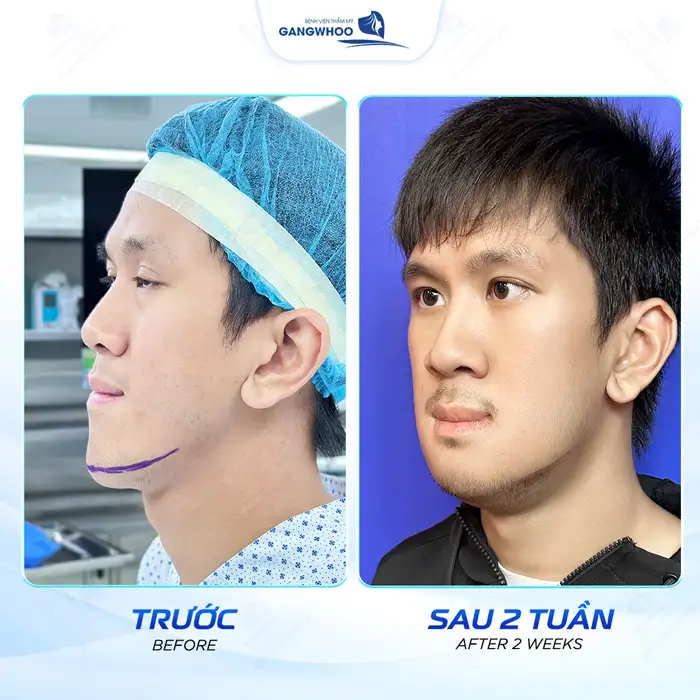 Gọt hàm hô giá bao nhiêu? Cập nhật bảng giá gọt hàm mới nhất 2026