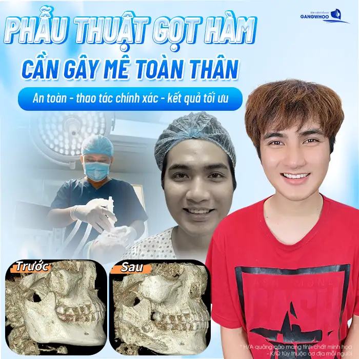 Gọt hàm hôn mê bao lâu? Quy trình gây mê diễn ra như thế nào?