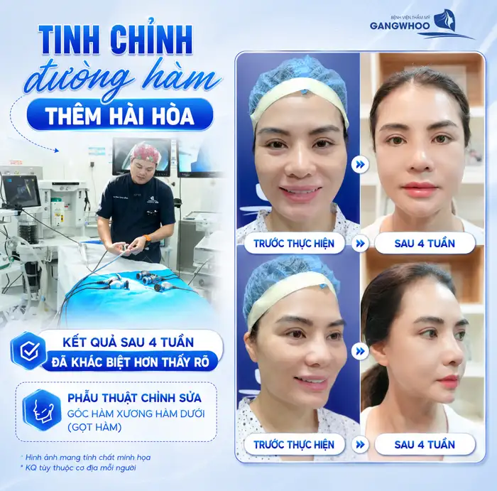 Gọt hàm nghỉ dưỡng bao lâu? Yếu tố ảnh hưởng thời gian nghỉ dưỡng
