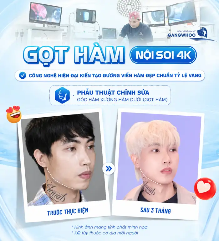 Gọt hàm nghỉ dưỡng bao lâu? Yếu tố ảnh hưởng thời gian nghỉ dưỡng