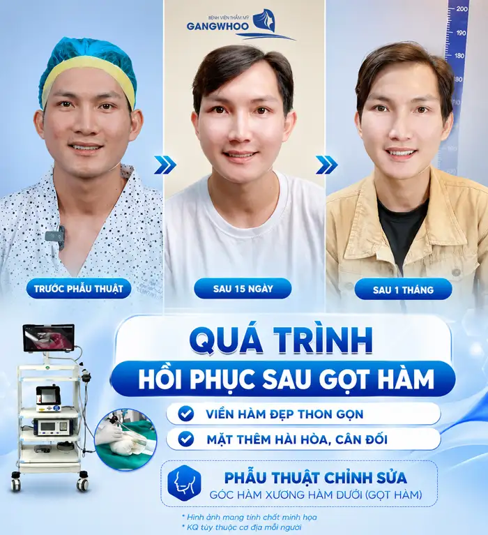 Gọt hàm nghỉ dưỡng bao lâu? Yếu tố ảnh hưởng thời gian nghỉ dưỡng