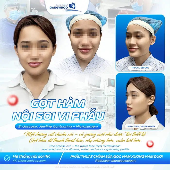 Gọt hàm V-line giá bao nhiêu? Bảng giá gọt hàm mới nhất 2026