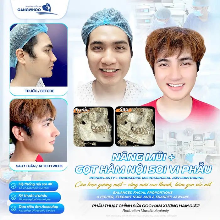 Gọt hàm V-line giá bao nhiêu? Bảng giá gọt hàm mới nhất 2026