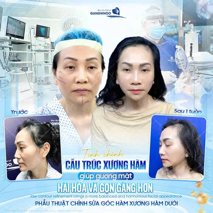 Gọt hàm V-line giá bao nhiêu? Bảng giá gọt hàm mới nhất 2026