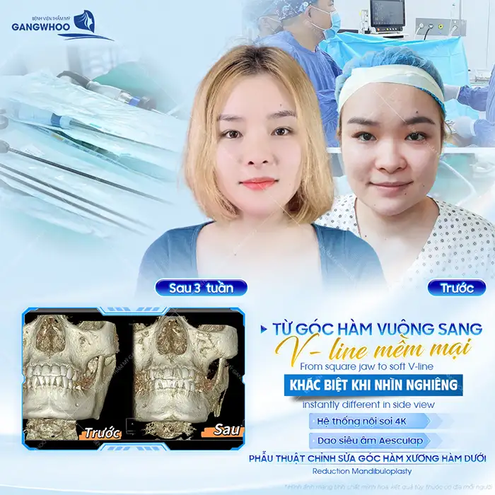 Gọt hàm V-line giá bao nhiêu? Bảng giá gọt hàm mới nhất 2026