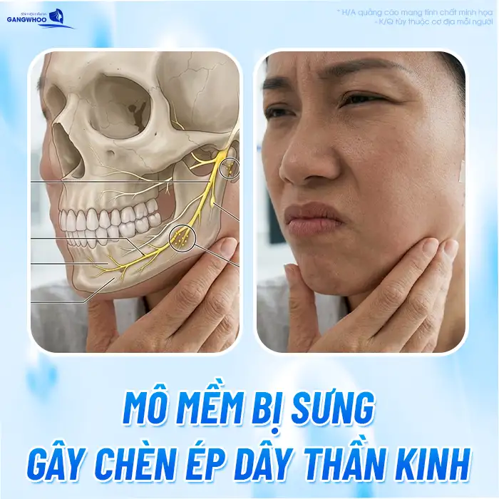 Gọt mặt có bị tê hàm mãi mãi không? Cách chăm sóc đúng cách