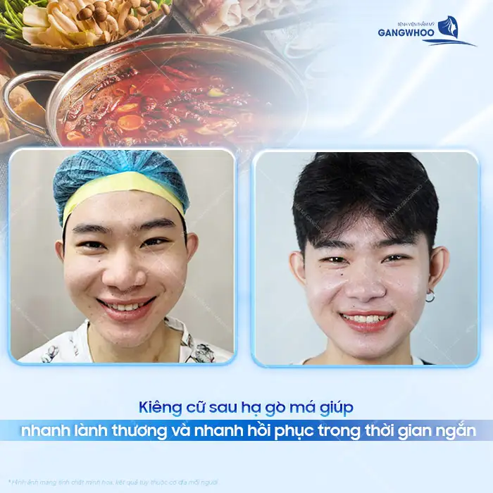 Hạ gò má cần kiêng những gì? Nên bổ sung loại thực phẩm nào?