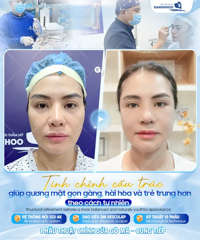 Hạ gò má có đau không? Có gây ra biến chứng gì không?