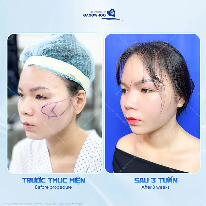 Hạ gò má có đau không? Có gây ra biến chứng gì không?