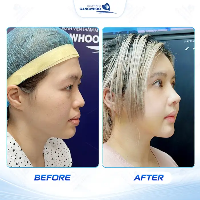 Hạ gò má có vĩnh viễn không? Thời gian duy trì sau khi hạ gò má